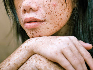 Taches brunes ou de soleil, comment les éviter ?