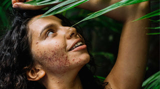 Cystic acne, what solutions?