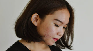 Comprendre les boutons sur le visage chez l'adulte