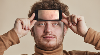 Acné hormonale : les hommes pas épargnés ?